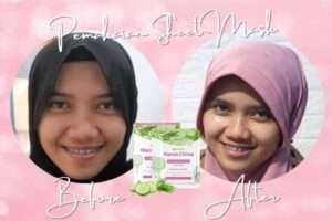 Sheet Mask yang Bagus untuk Kulit Sensitif & Berjerawat dari Mama’s Choice
