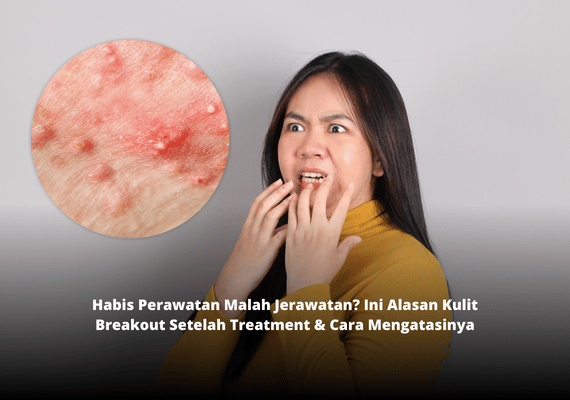 Habis Perawatan Malah Jerawatan? Ini Alasan Kulit Breakout Setelah Treatment & Cara Mengatasinya